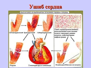 Ушиб сердцаУшиб сердца
 