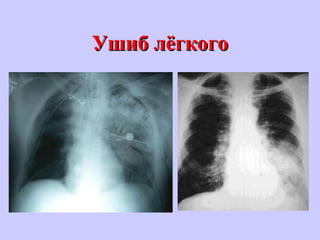 Ушиб лёгкогоУшиб лёгкого
 