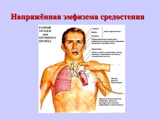 Напряжённая эмфизема средостенияНапряжённая эмфизема средостения
 