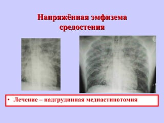 Напряжённая эмфиземаНапряжённая эмфизема
средостениясредостения
• Лечение – надгрудинная медиастинотомия
 