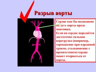 Разрыв аортыРазрыв аорты
Сердце как бы подвешено
на дуге аорты вроде
маятника.
Если на сердце передаётся
достаточно сильная
перегрузка (например,
торможение при взрывной
травме, столкновение с
препятствием) сердце
может оторваться от
аорты.
 