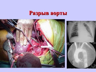 Разрыв аортыРазрыв аорты
 