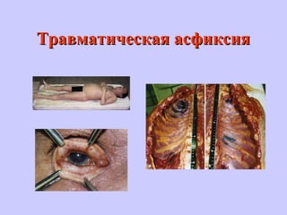 Травматическая асфиксияТравматическая асфиксия
 
