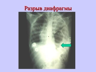 Разрыв диафрагмыРазрыв диафрагмы
 