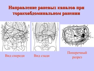 Направление раневых каналов приНаправление раневых каналов при
торакоабдоминальном раненииторакоабдоминальном ранении
Вид спереди Вид сзади
Поперечный
разрез
 