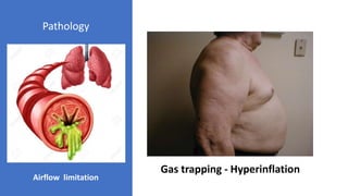 Gas trapping - Hyperinflation
Airflow limitation
Pathology
 