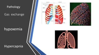Gas exchange
hypoxemia
Hypercapnia
 