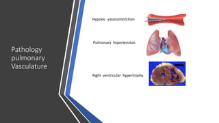 Pathology
pulmonary
Vasculature
Right ventricular hypertrophy
Pulmonary hypertension.
Hypoxic vasoconstriction
 