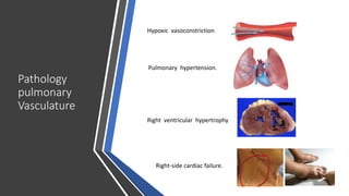 Pathology
pulmonary
Vasculature
Right ventricular hypertrophy
Pulmonary hypertension.
Hypoxic vasoconstriction
Right-side cardiac failure.
 