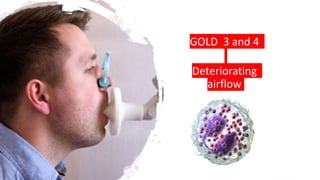 GOLD 3 and 4
Deteriorating
airflow
 