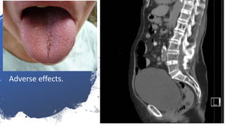 Anti
muscarinic
Adverse effects.
 