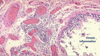 Chronic
inflammation
 