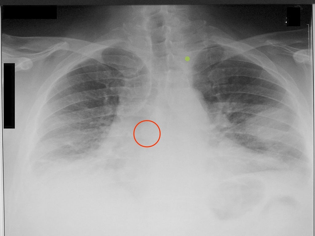 VQ scan of lung