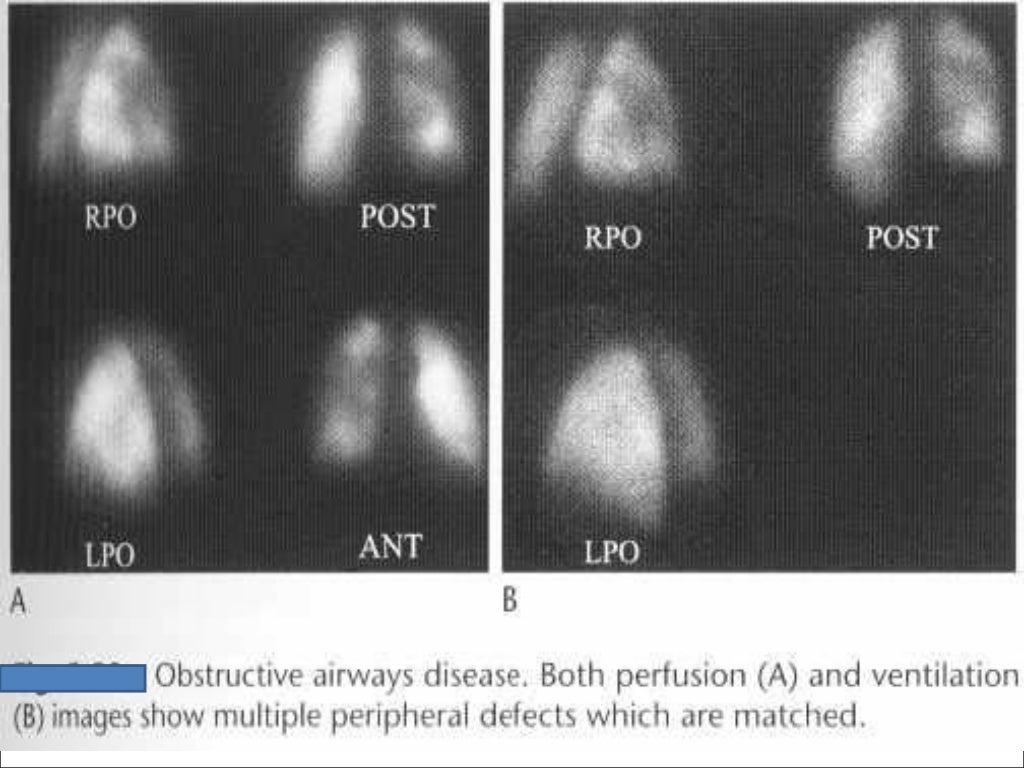 VQ scan of lung
