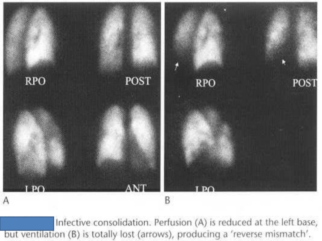 VQ scan of lung