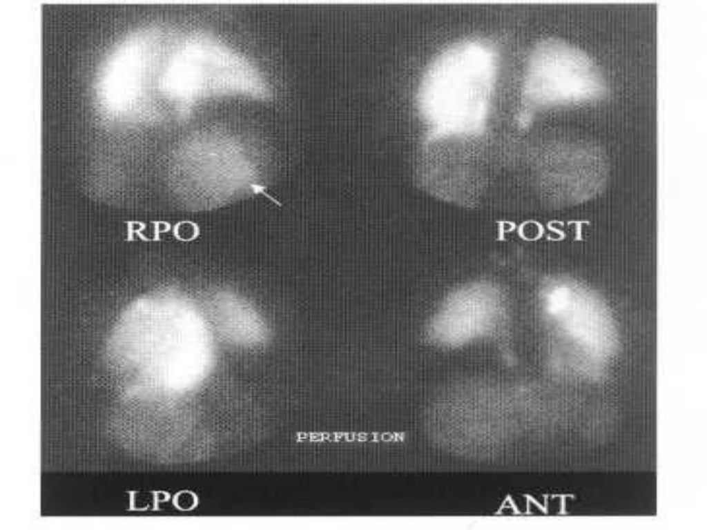 VQ scan of lung