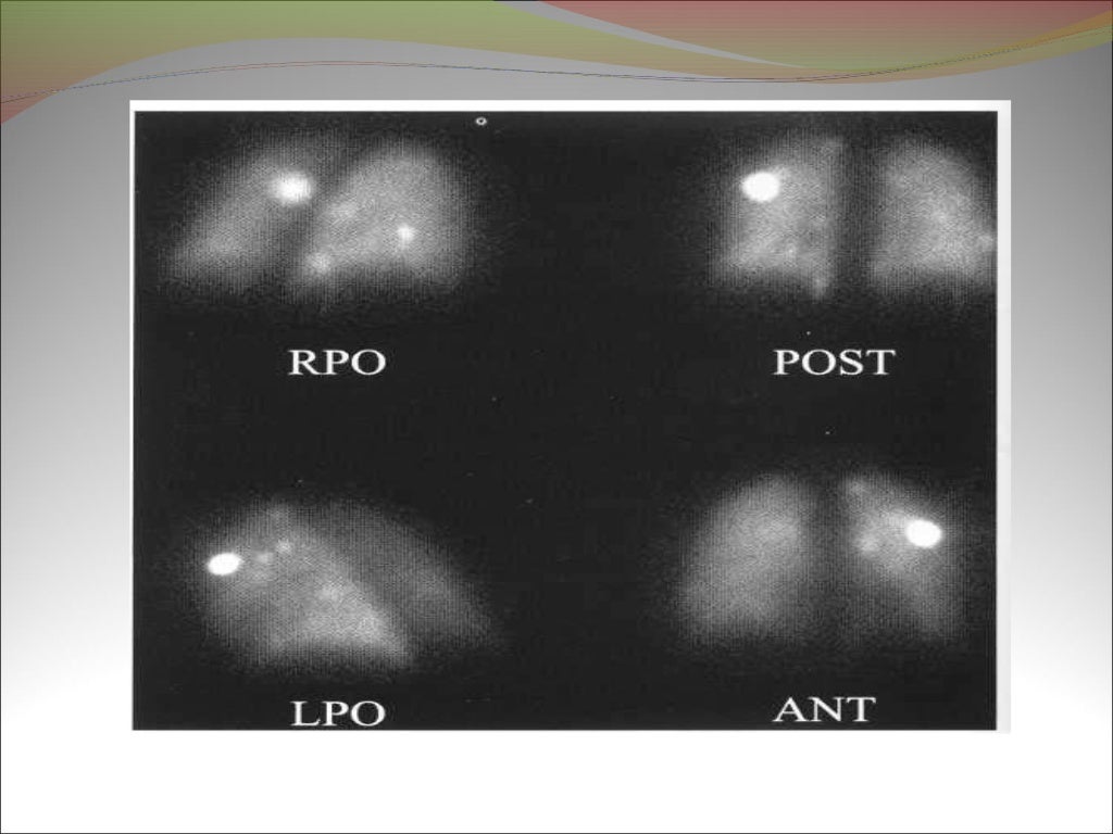 VQ scan of lung