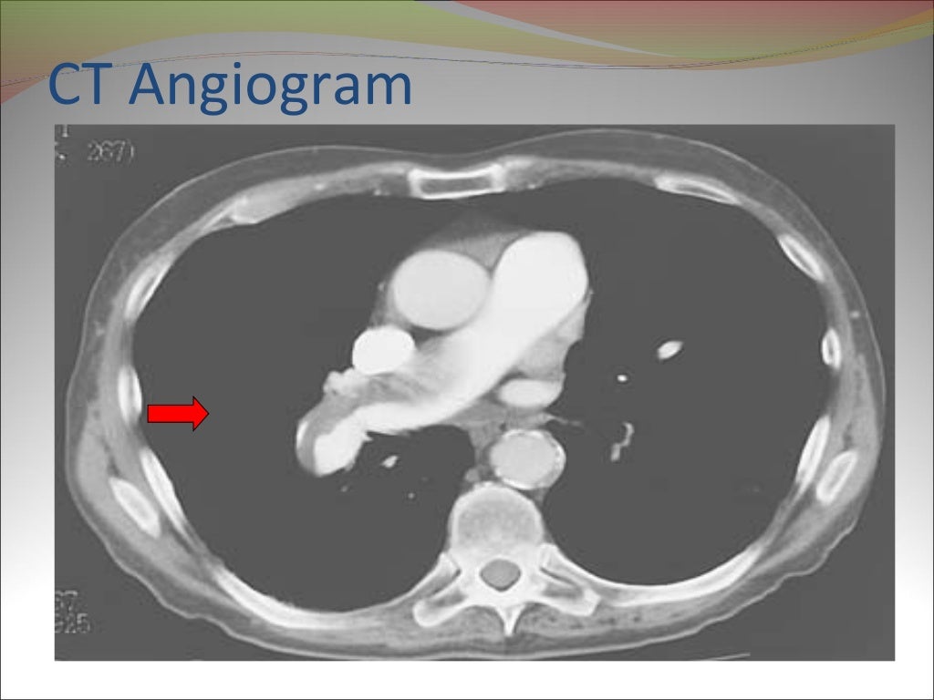 VQ scan of lung