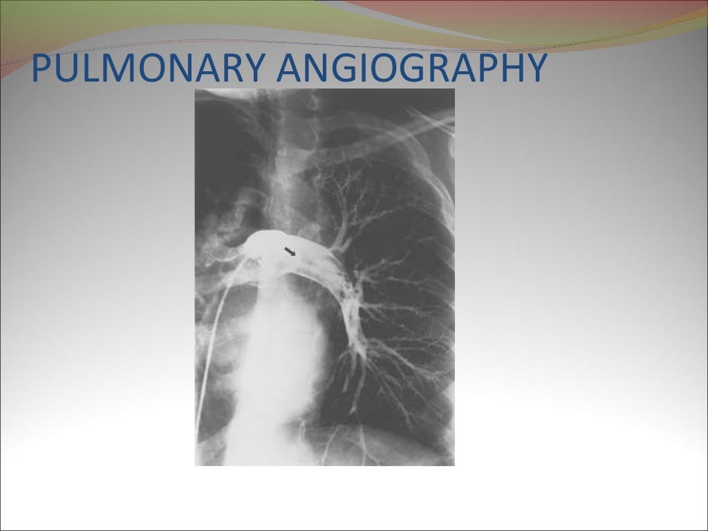VQ scan of lung