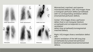 Imaging in VQ SCANS IN ACUTE PE rad.pptx