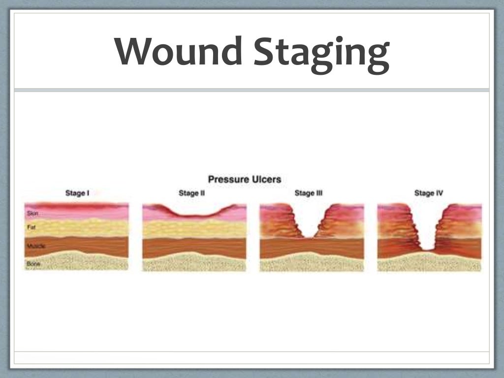 Pressure ulcers in a spinal cord injury patient