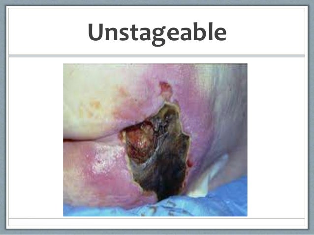 Pressure ulcers in a s...
