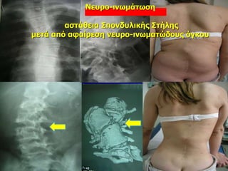 Νευρο-ινωμάτωση
αστάθεια Σπονδυλικής Στήλης
μετά από αφαίρεση νευρο-ινωματώδους όγκου
 