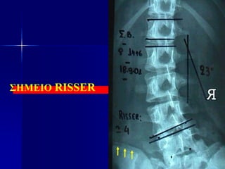 ΣΗΜΕΙΟ RISSER
 