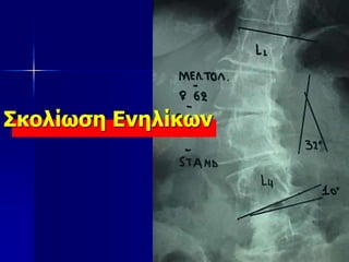 Σκολίωση Ενηλίκων
 