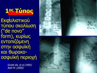 1ος Τύπος
Εκφυλιστικού
τύπου σκολίωση
(‘‘de novo’’
form), κυρίως
εντοπιζόμενη
στην οσφυϊκή
και θωρακο-
οσφυϊκή περιοχή
Grubb SA, et al (1992)
Aebi M. (2005)
 