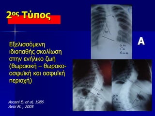 2ος Τύπος
Εξελισσόμενη
ιδιοπαθής σκολίωση
στην ενήλικο ζωή
(θωρακική – θωρακο-
οσφυϊκή και οσφυϊκή
περιοχή)
Ascani E, et al, 1986
Aebi M. , 2005
A
 