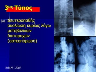 3ος Τύπος
(a) Δευτεροπαθής
σκολίωση κυρίως λόγω
μεταβολικών
διαταραχών
(οστεοπόρωση)
Aebi M. , 2005
 