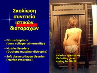 Σκολίωση
συνεπεία
ιστικών
διαταραχών
(Marfan syndrome)
Defecting gene
coding for fibrilin
• Fibrus dysplacia
(bone collagen abnormality)
• Muscle disorders
(Duchene musclear distrophy)
• Soft tissue collagen disorder
(Marfan syndrome)
 