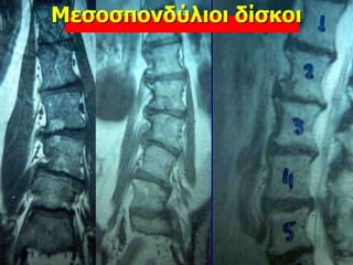 Μεσοσπονδύλιοι δίσκοι
 