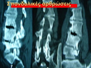 Σπονδυλικές αρθρώσεις
 