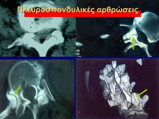Πλευροσπονδυλικές αρθρώσεις
 