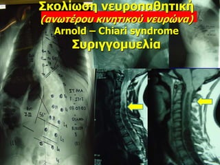 Σκολίωση νευροπαθητική
(ανωτέρου κινητικού νευρώνα)
Arnold – Chiari syndrome
Συριγγομυελία
 
