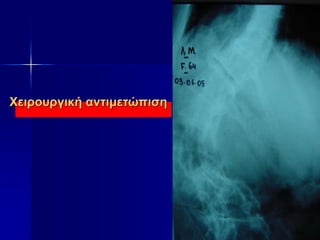 Χειρουργική αντιμετώπιση
 