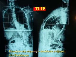 TLIF
Εκφυλιστική κύφωση – σκολίωση ενήλικος
(+) Parkinson
 
