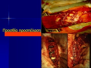 Προσθία προσπέλαση
 