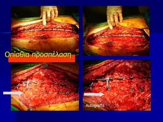 Autografts
Οπίσθια προσπέλαση
 