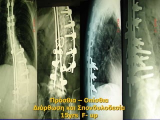 Πρόσθια – Οπίσθια
Διόρθωση και Σπονδυλοδεσία
15yrs F- up
 