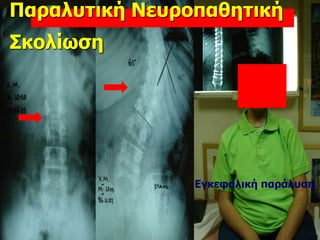 Παραλυτική Νευροπαθητική
Σκολίωση
Εγκεφαλική παράλυση
 