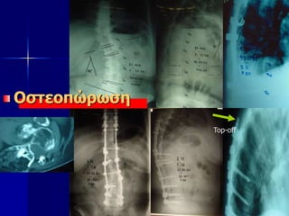 Top-off
Οστεοπώρωση
 