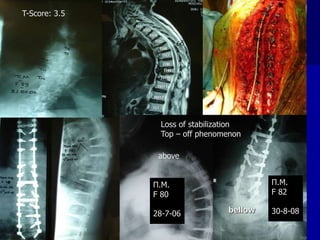 Π.Μ.
F 80
28-7-06
Π.Μ.
F 82
30-8-08
Loss of stabilization
Top – off phenomenon
above
bellow
T-Score: 3.5
 