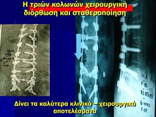 Η τριών κολωνών χειρουργική
διόρθωση και σταθεροποίηση
Δίνει τα καλύτερα κλινικά – χειρουργικά
αποτελέσματα
 
