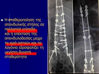  Η σταθεροποίηση της
σπονδυλικής στήλης σε
πολλαπλά επίπεδα
και η επέκταση της
σπονδυλοδεσίας μεχρι
το ιερό οστούν και τα
λαγόνια εξασφαλίζει τη
μεγίστη δυνατή
σταθερότητα
 