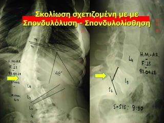 Σκολίωση σχετιζομένη με με
Σπονδυλόλυση - Σπονδυλολίσθηση
 