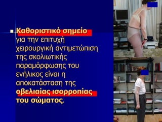  Καθοριστικό σημείο
για την επιτυχή
χειρουργική αντιμετώπιση
της σκολιωτικής
παραμόρφωσης του
ενήλικος είναι η
αποκατάσταση της
οβελιαίας ισορροπίας
του σώματος.
 