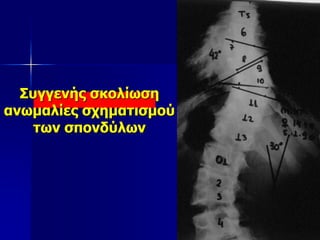 Συγγενής σκολίωση
ανωμαλίες σχηματισμού
των σπονδύλων
 